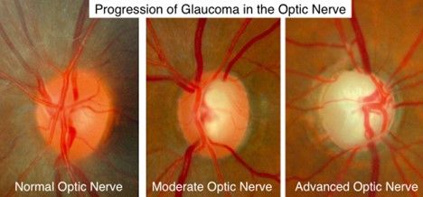 Progression of Glaucoma in the Optic Nerve