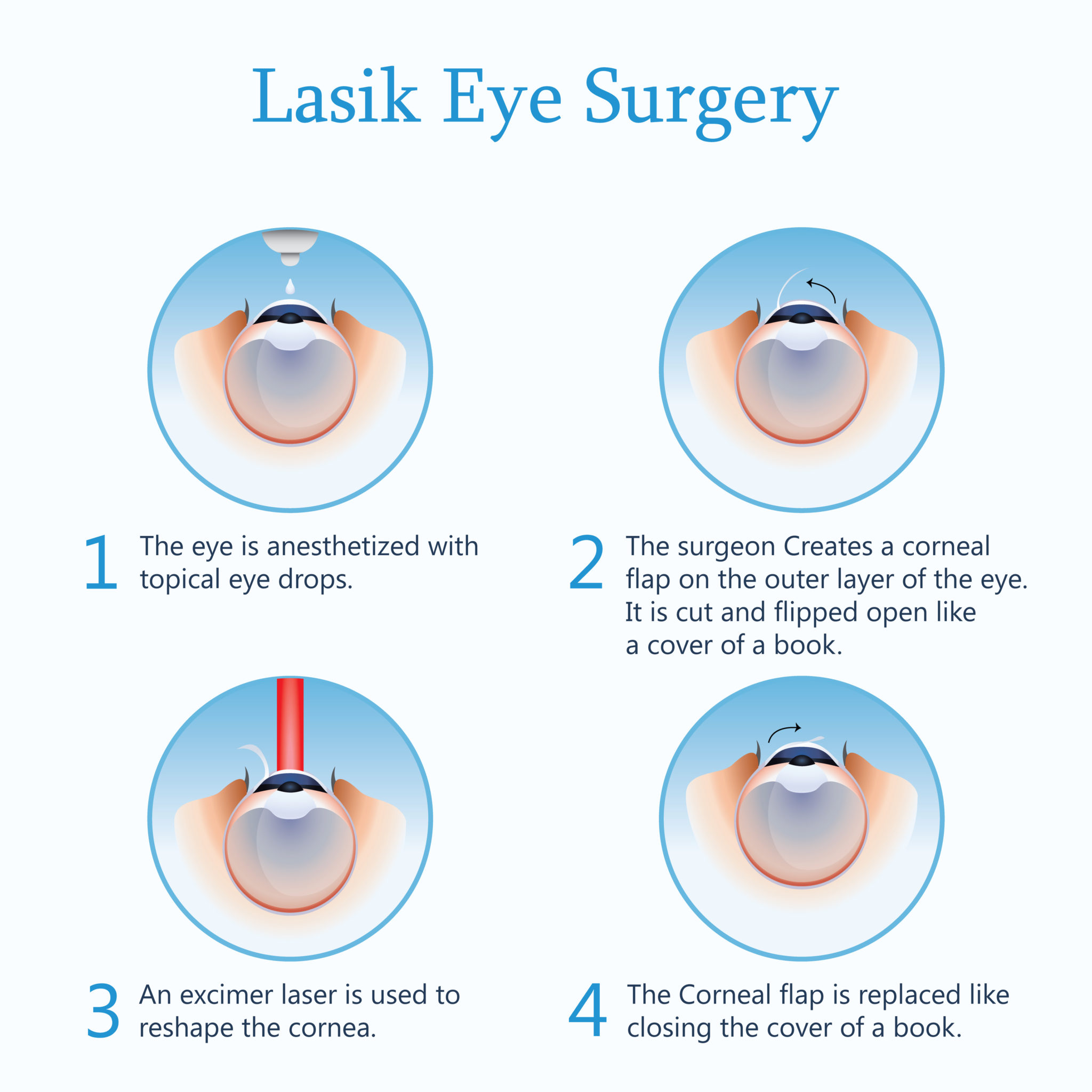 How Long Does Lasik Last For? Tucson Optometry Clinic